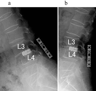 Spinous process plate (S-plate) fixation after posterior interbody ...