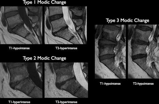 edematous degenerative endplate changes