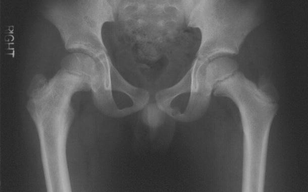 Ipsilateral femoral neck and shaft fracture in children: a ...