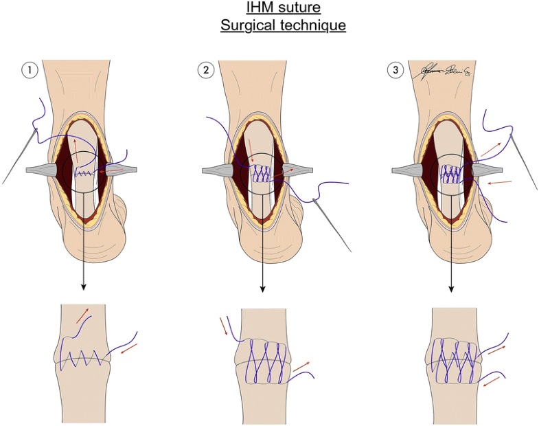 Interlocking horizontal mattress suture versus Kakiuchi technique in