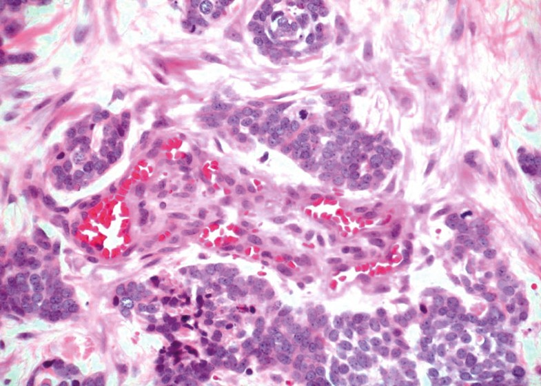 Metastatic Basal Cell Carcinoma Report of Two Cases and Literature