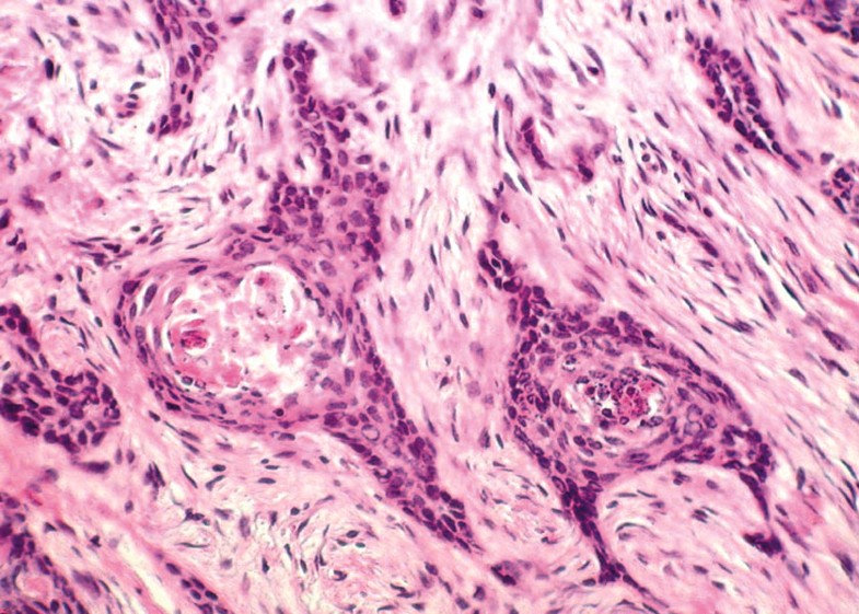 Metastatic Basal Cell Carcinoma Report of Two Cases and Literature