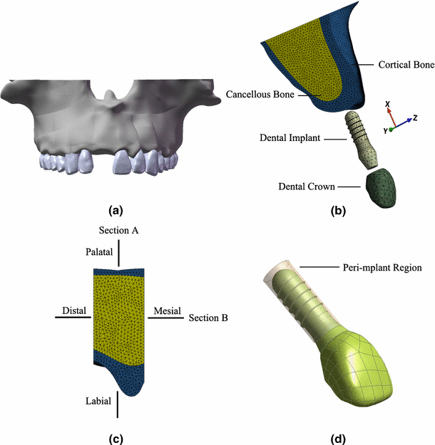 Simulated bone remodeling around tilted dental implants in the anterior