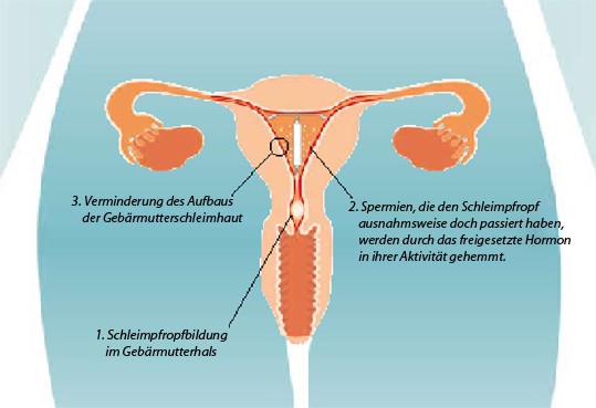 Intrauterine Hormonelle Kontrazeption Springerlink - 