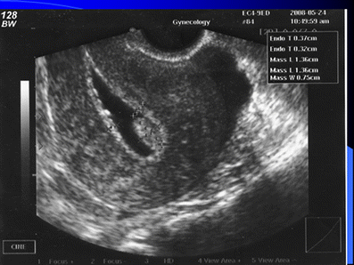 hysteroscopy reliability abnormal uterine