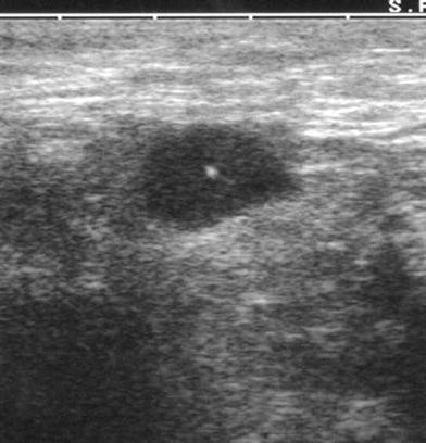 Accuracy Of Fine Needle Aspiration Cytology Fnac Of Axillary