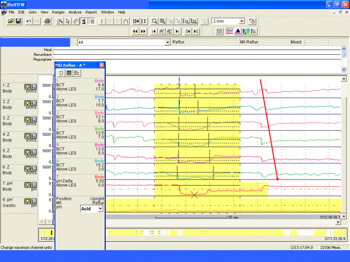 ImpedancepH Monitoring for Diagnosis of Reflux Disease New