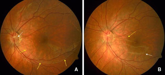 Function and morphology in macular retinoschisis associated with optic ...