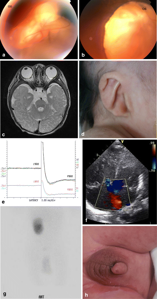 mild charge syndrome mild charge syndrome
