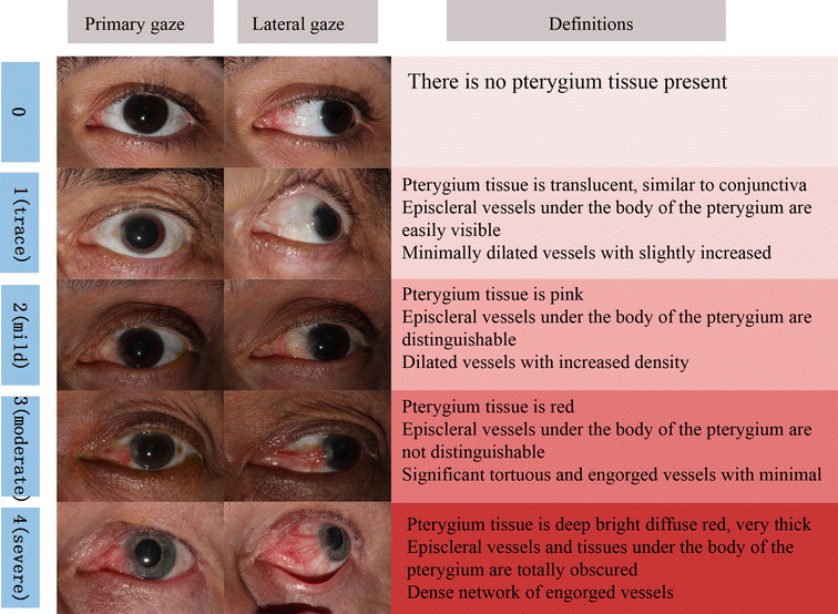 Validity of a new comprehensive pterygia grading scale for use in