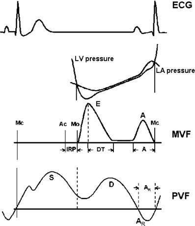 Diastolic dysfunction and atrial fibrillation | SpringerLink