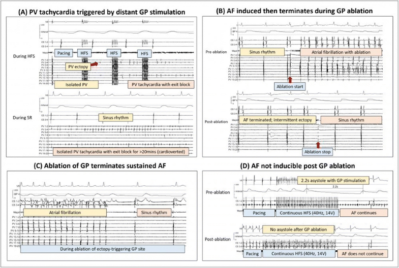 Plexus Pv Chart