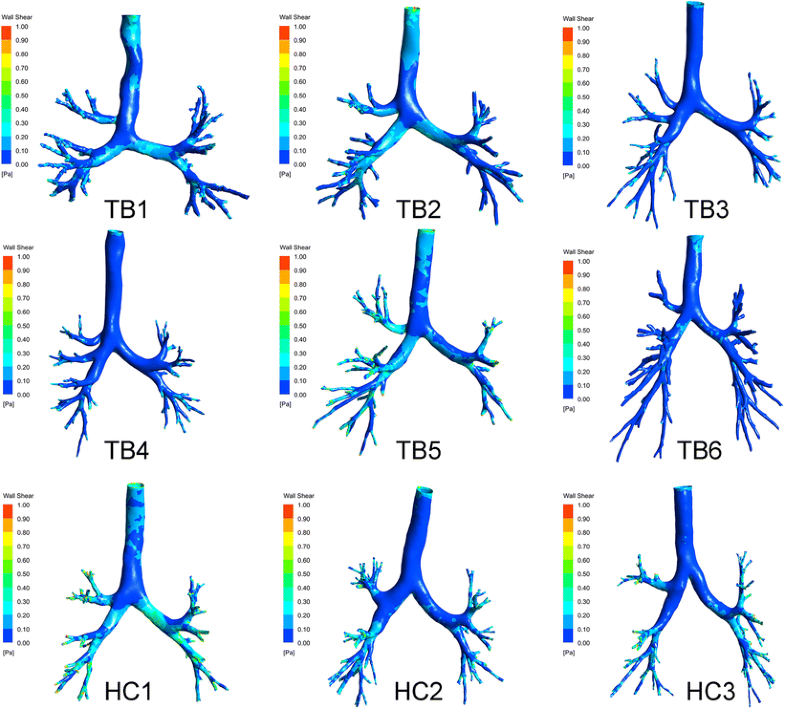 Airflow in Tracheobronchial Tree of Subjects with Tracheal Bronchus