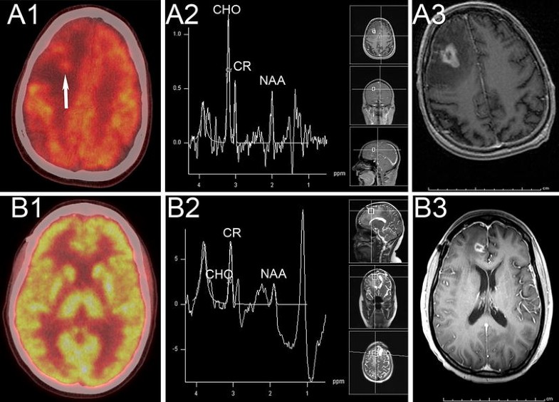 Stereotactic laser induced thermotherapy (LITT) a novel treatment for