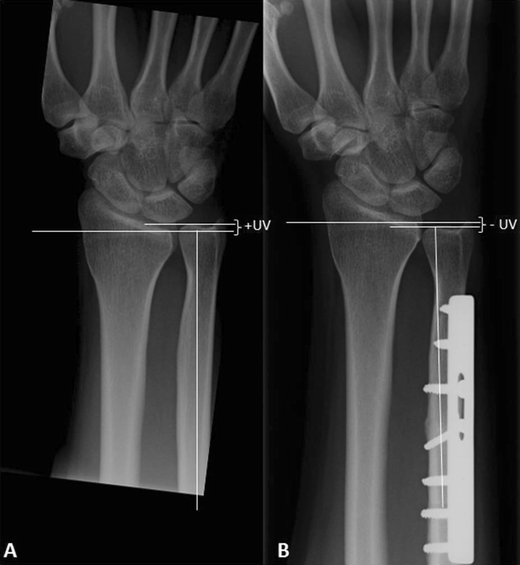 MidTerm Results Following Ulna Shortening Osteotomy SpringerLink