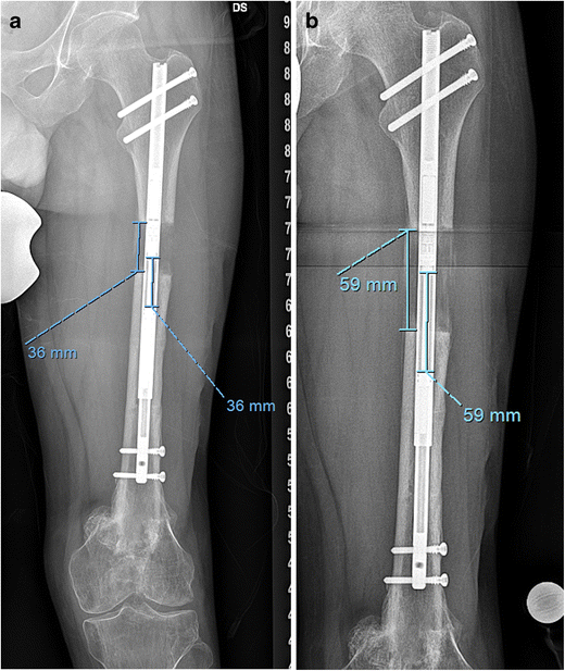 A Comparison of Femoral Lengthening Methods Favors the