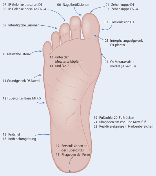 Das Entitätenkonzept des diabetischen Fußsyndroms | SpringerLink