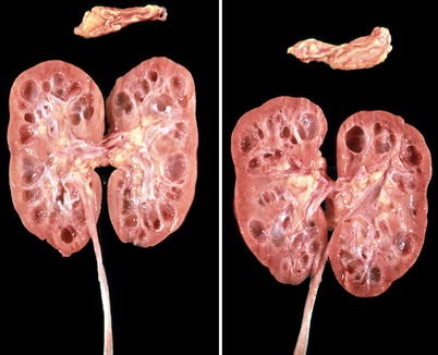 Nephronophthise SpringerLink