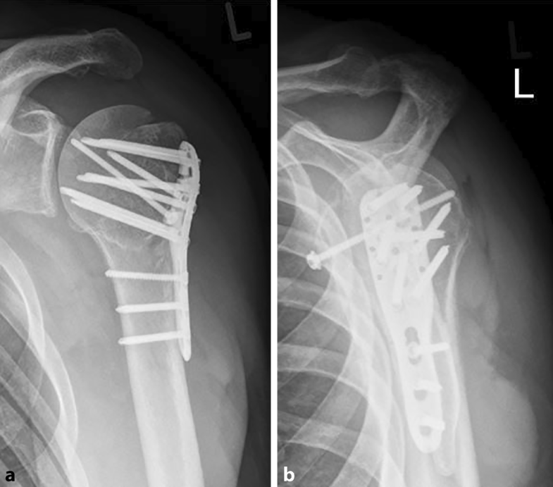 Headsplit fractures of the proximal humerus SpringerLink