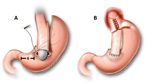 Laparoscopic Sleeve-Collis-Nissen Gastroplasty: a Safe Alternative for ...