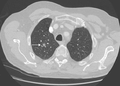 Amoxicilline arrow 1g Amoxicilline arrow 1g