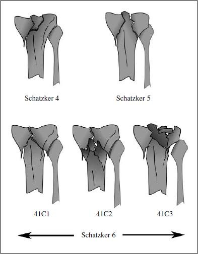 Treatment Of High Energy Tibial Plateau Fractures Springerlink