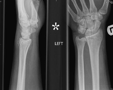 Distal radius fracture management in elderly patients a literature review