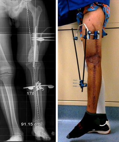 femur fig