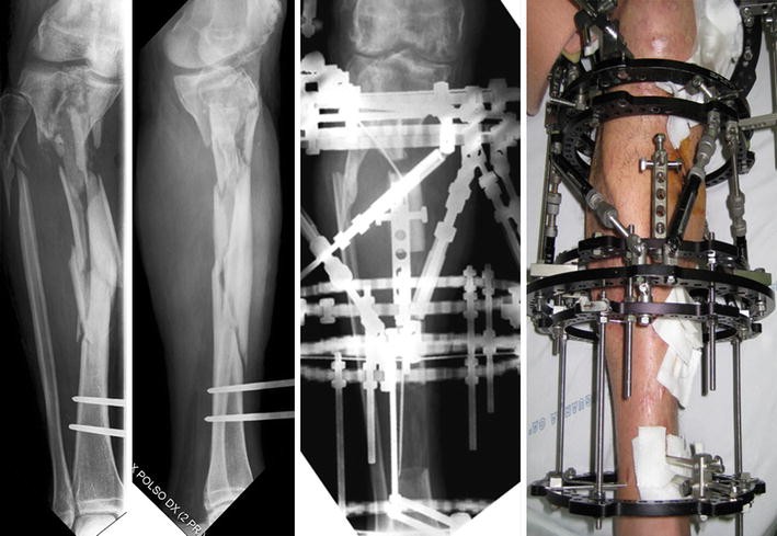 Distraction osteogenesis for tibial nonunion with bone loss using ...
