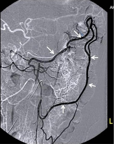 Viszerale Durchblutungsstörungen | SpringerLink