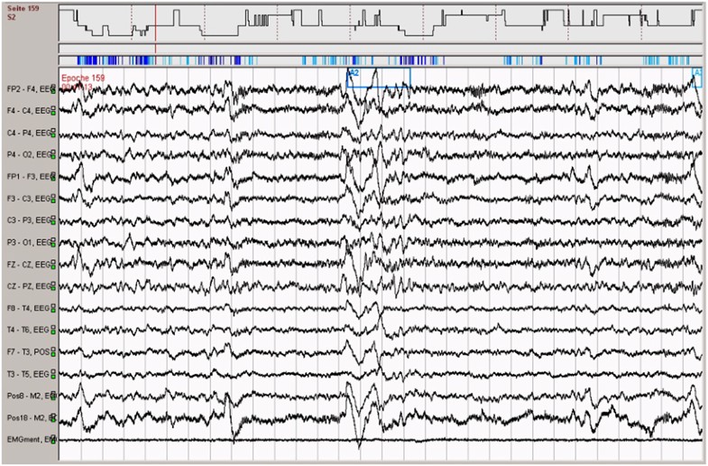 „Cyclic alternating pattern“ SpringerLink