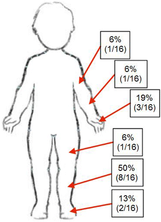 Compartment Syndrome In Infants And Toddlers 