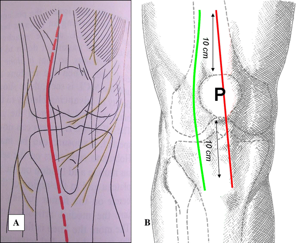 Hypesthesia after Anterolateral versus Midline Skin Incision in TKA: A ...