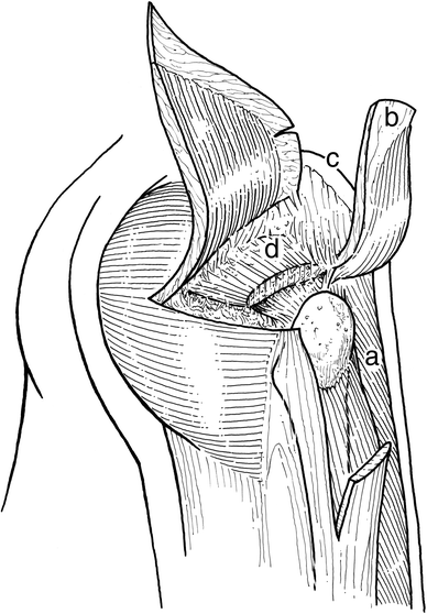 Surgical Technique: Gluteus Maximus and Tensor Fascia Lata Transfer for