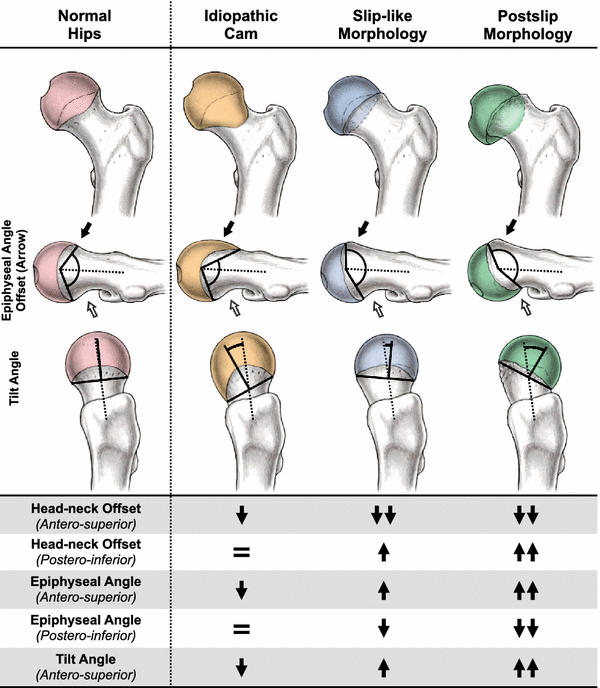 Twelve Percent of Hips With a Primary Cam Deformity Exhibit a Sliplike