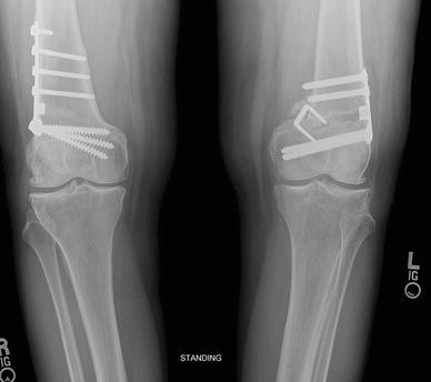 osteotomy fig distal femoral lateral wedge opening