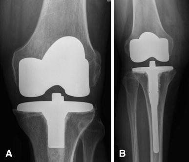 Do Stemmed Tibial Components in Total Knee Arthroplasty Improve ...