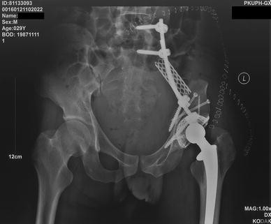 Acetabular Reconstruction With Femoral Head Autograft After ...