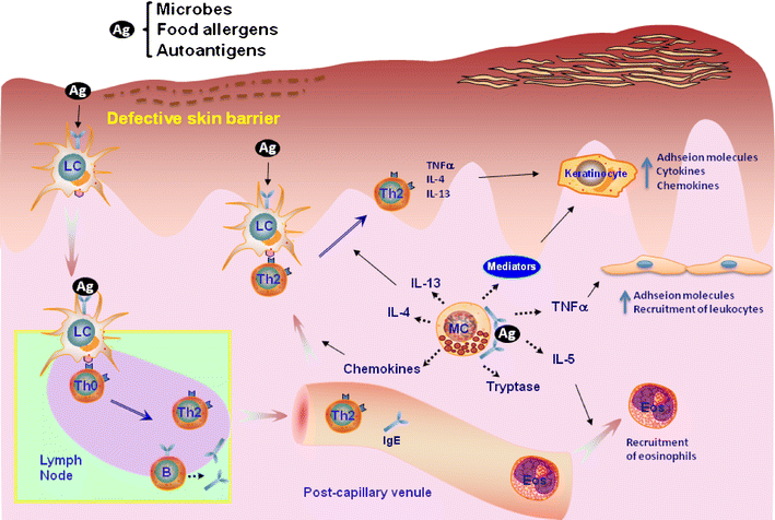 IgE, Mast Cells, and Eosinophils in Atopic Dermatitis | SpringerLink
