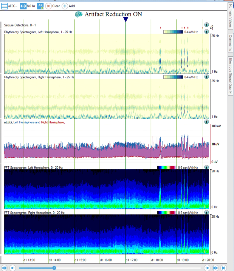 Quantitative Continuous EEG Bridging the Gap Between the ICU Bedside