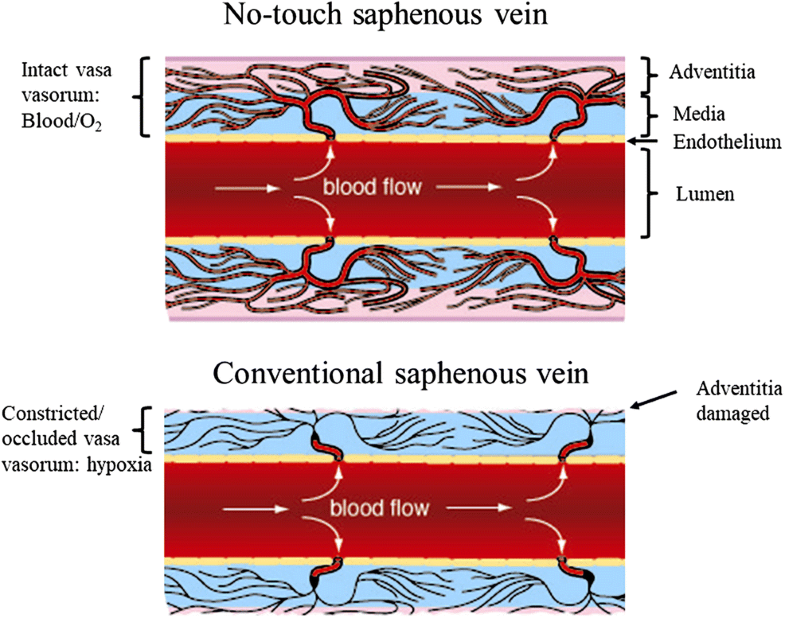Vasa vasorum inside out/outside in communication a potential role in