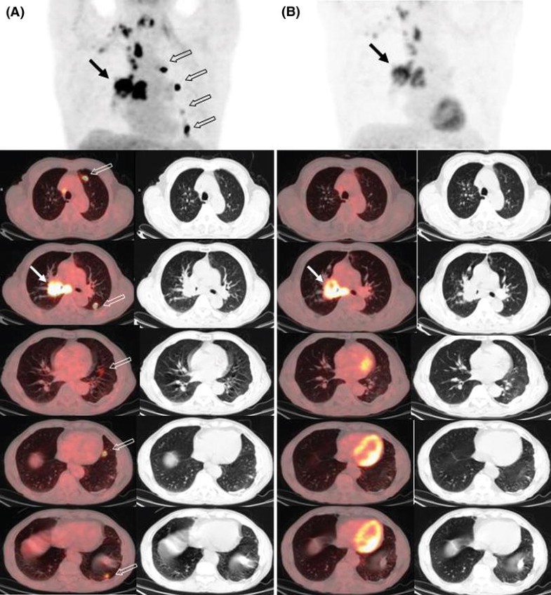 Incidental focal F-18 FDG accumulation in lung parenchyma without