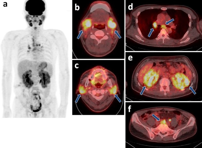 Role of F-18 FDG PET/CT in assessing IgG4-related disease with ...