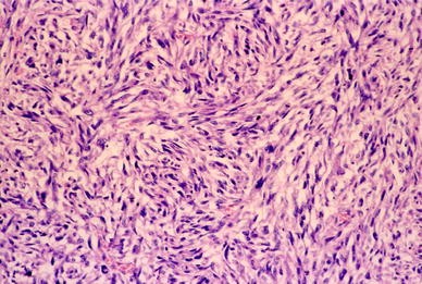Pathology of mesothelioma | SpringerLink