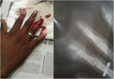 Ring Finger Necrosis Due To A Ring Springerlink