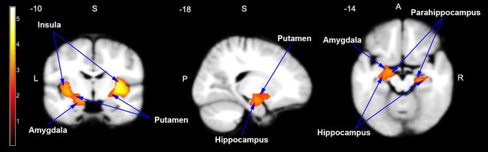 How Autism Changes Brain Scans Of >> A Volumetric And Functional Connectivity Mri Study Of Brain Arginine How Autism Changes Brain Scans Of >> A Volumetric And Functional Connectivity Mri Study Of Brain Arginine