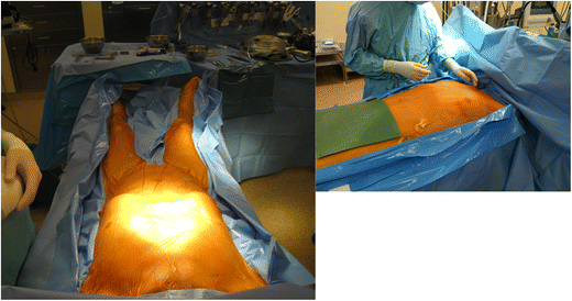 Comparison Of Efficacy And Cost Of Iodine Impregnated Drape Vs