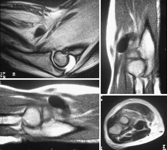 Acute compartment syndrome of the forearm caused by calcific tendinitis