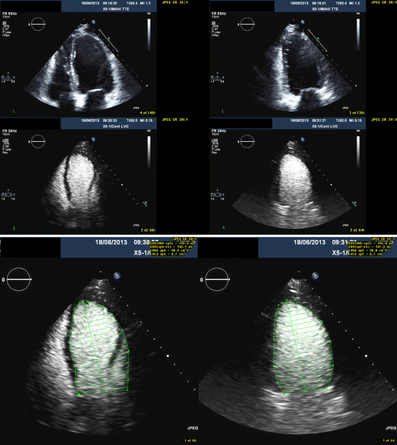 Contrast Echocardiography Current Applications and Future Perspectives