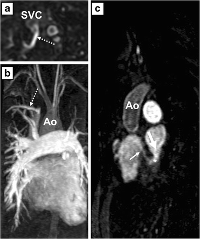 Unroofed coronary sinus newly diagnosed in adult patients after